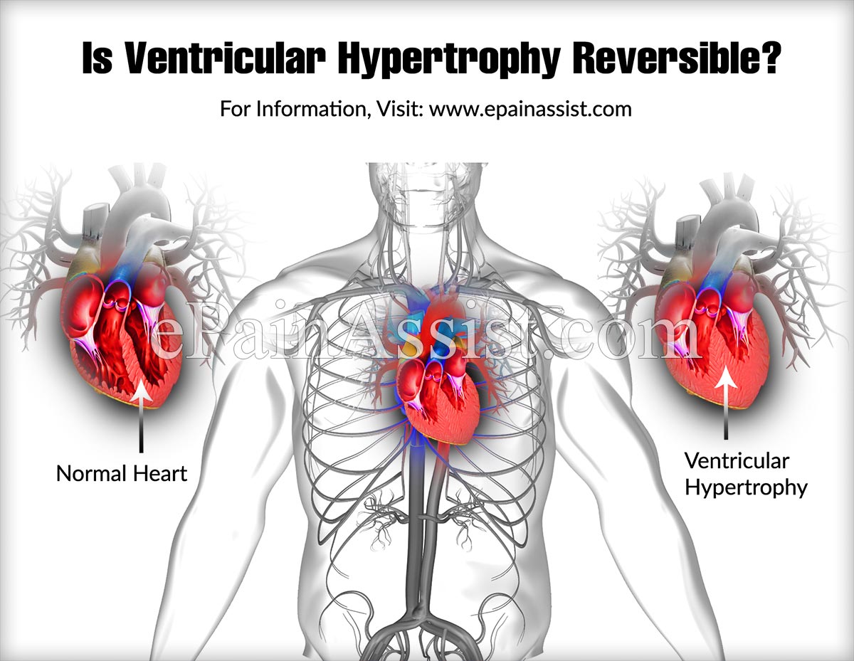 Is Ventricular Hypertrophy Reversible?