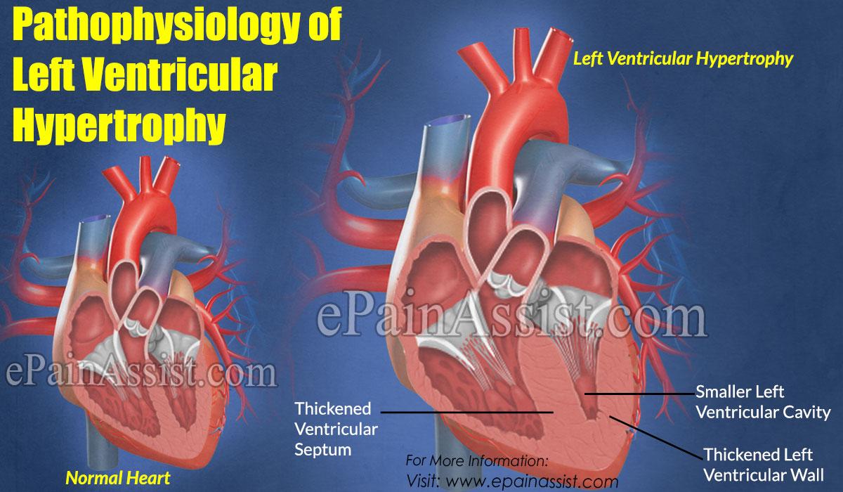 Pathophysiology of Left Ventricular Hypertrophy