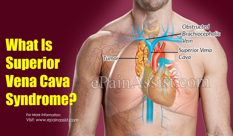 Superior Vena Cava Syndrome: Causes, Symptoms, Treatment, Prognosis