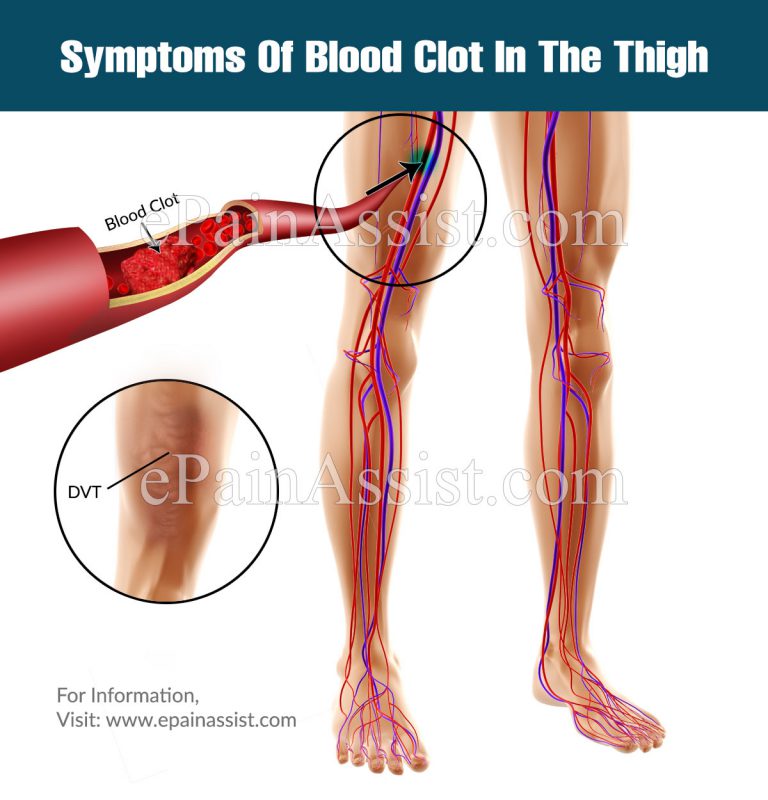 Symptoms of Blood Clot in Thigh & Its Treatments