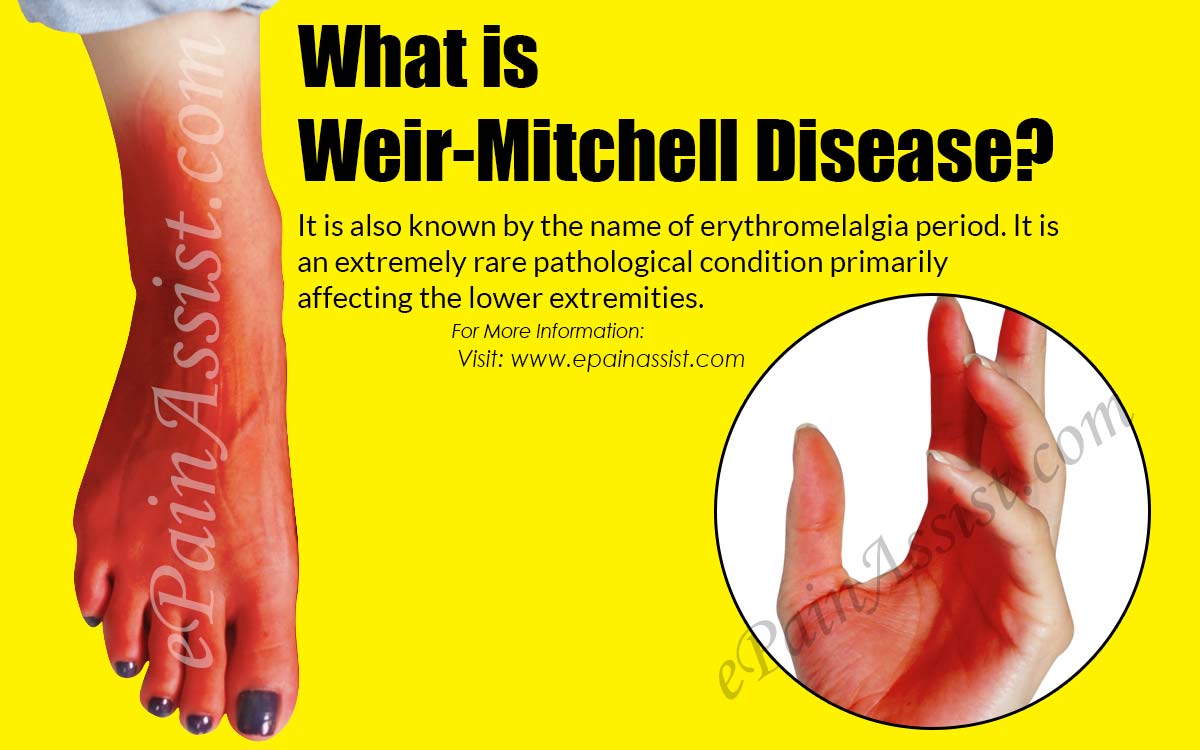 What is Weir-Mitchell Disease?
