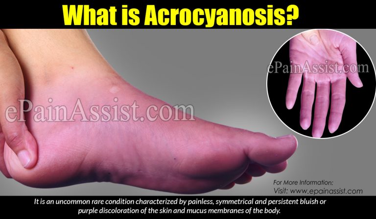 Acrocyanosis: Etiology, Signs, Symptoms, Treatment
