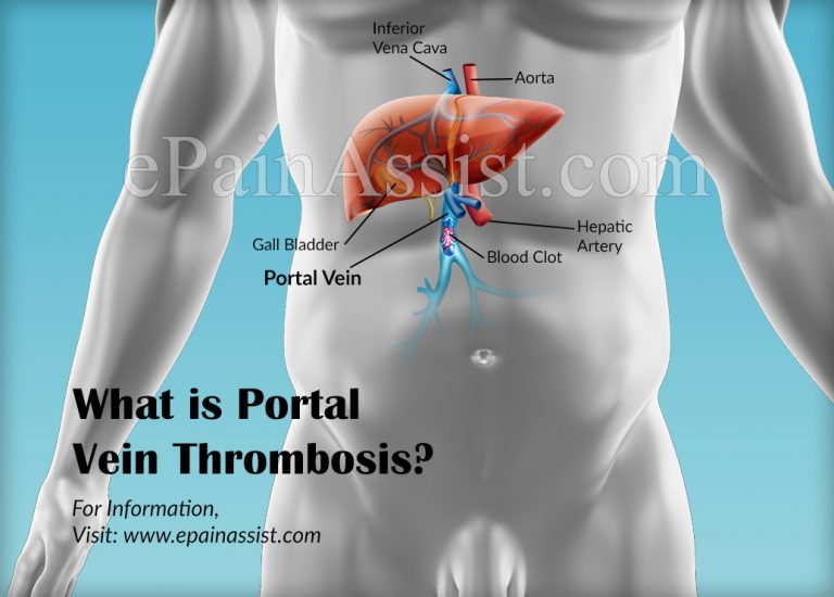 What Are The Portal Vein Thrombosis Complications?
