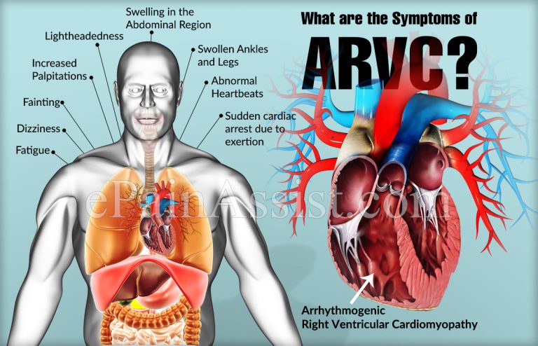 What are the Symptoms of ARVC?