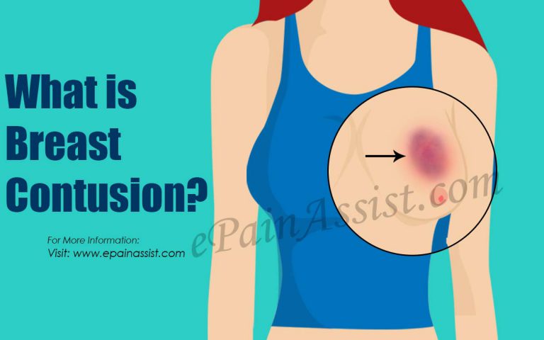 Breast Contusion or Bruise on Breast