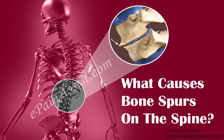 What Causes Bone Spurs On The Spine?