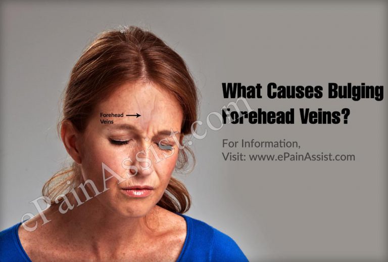 What Causes Bulging Forehead Veins & How is it Treated?