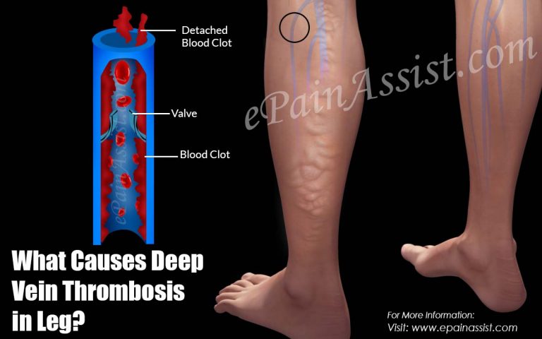 What Causes DVT or Deep Vein Thrombosis in Leg?