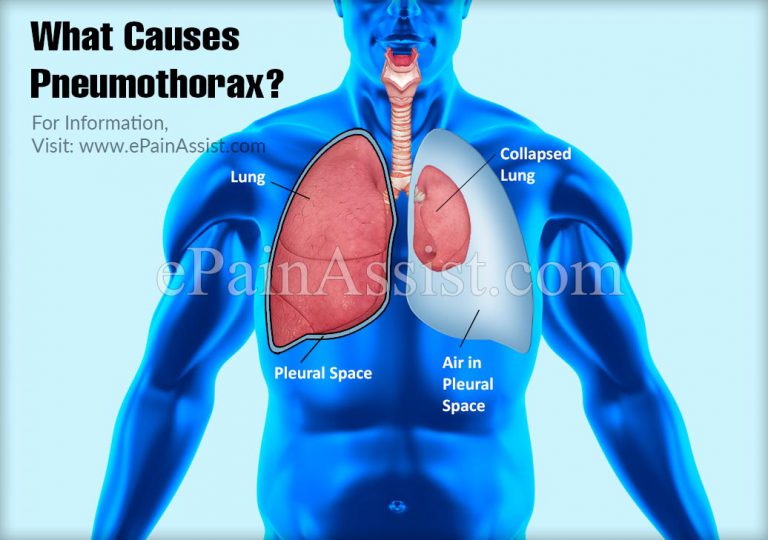 What Causes Pneumothorax?