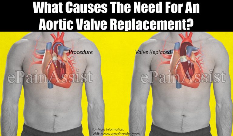 What Causes The Need For An Aortic Valve Replacement?