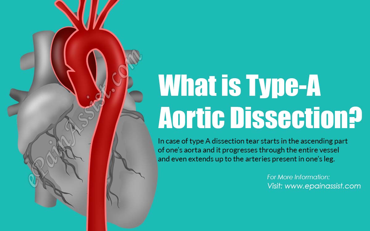 What is a Type-A Aortic Dissection?