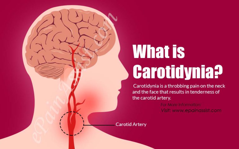 What is Carotidynia & How is it Treated?|Causes, Symptoms, Diagnosis of Carotidynia