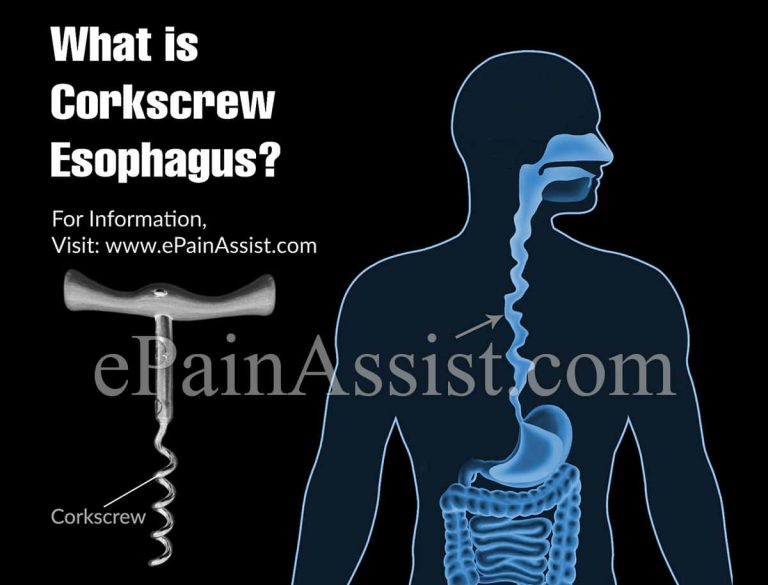 What is Corkscrew Esophagus & How is it Treated?|Causes & Symptoms of Corkscrew Esophagus