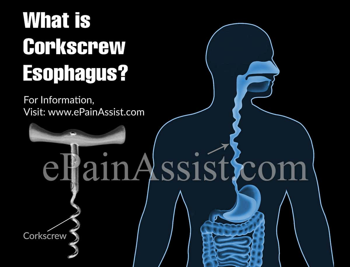 What is Corkscrew Esophagus?