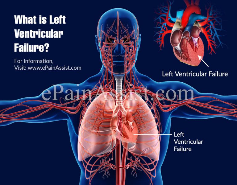What Is Left Ventricular Failure?