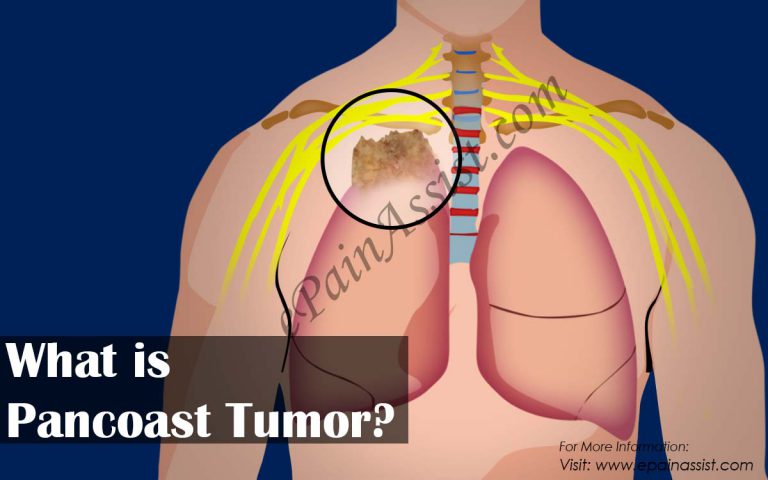What is Pancoast Tumor & How is it Treated?|Causes, Symptoms, Survival Rate of Pancoast Tumor