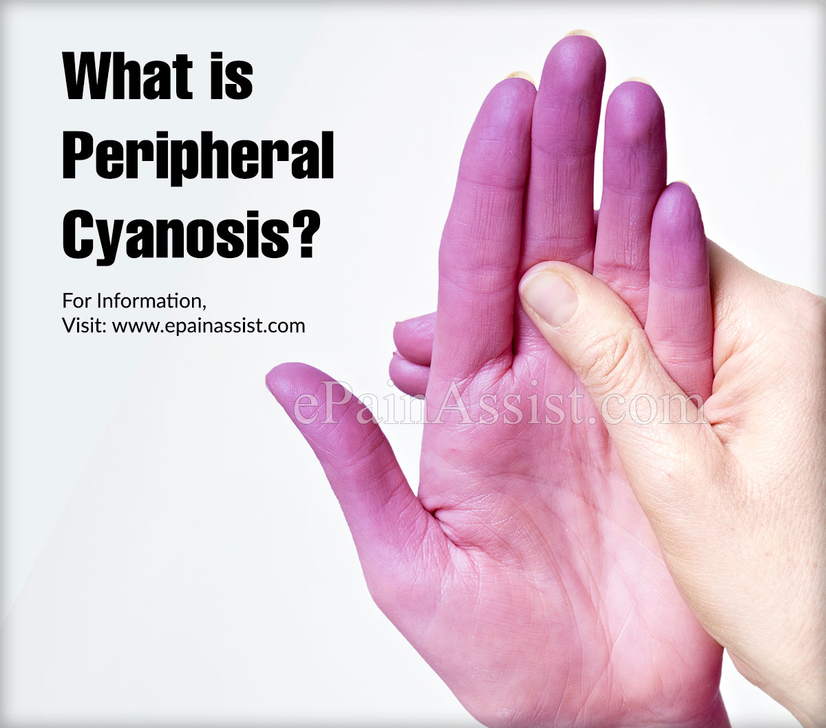 What is Peripheral Cyanosis?