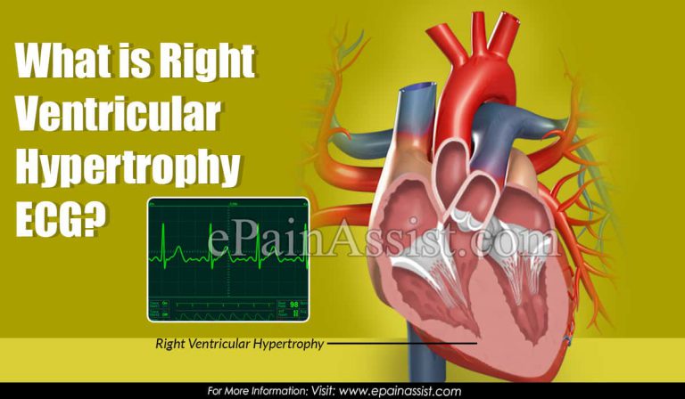 What is Right Ventricular Hypertrophy ECG?