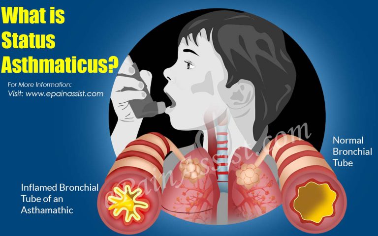 What is Status Asthmaticus & How is it Treated?|Causes, Symptoms, Prognosis of Status Asthmaticus