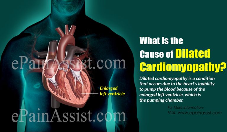 What is the Cause of Dilated Cardiomyopathy?