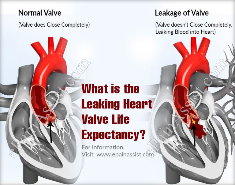 What is the Leaking Heart Valve Life Expectancy?