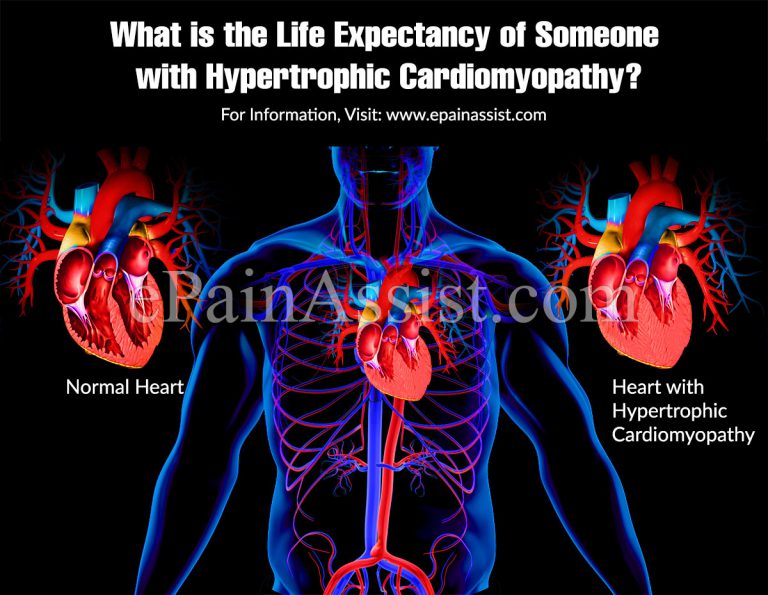 What is the life expectancy of someone with hypertrophic cardiomyopathy