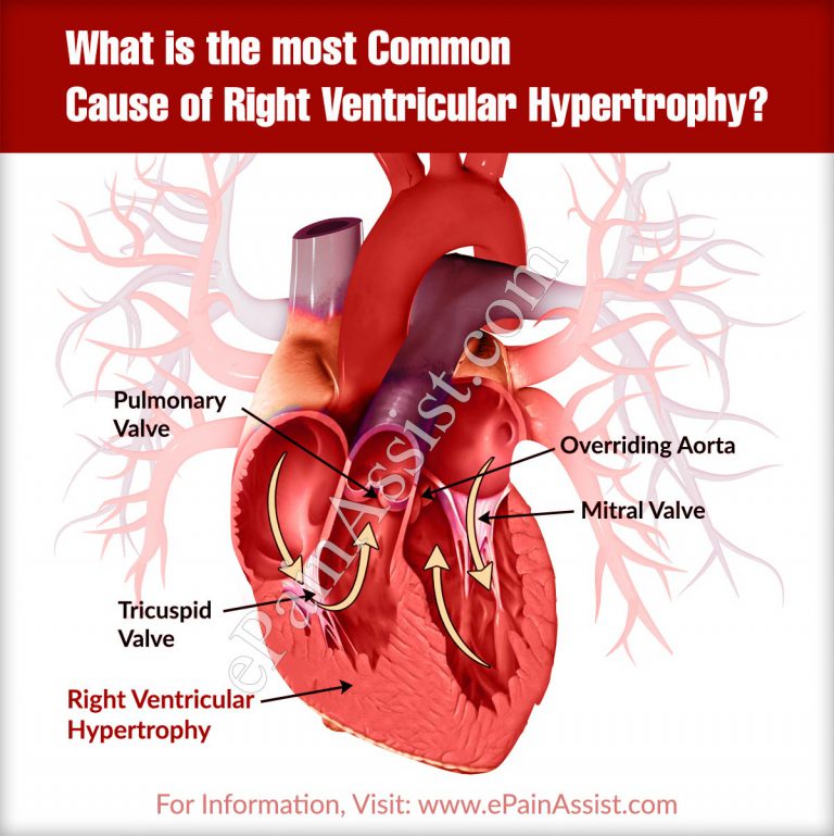 What Is The Most Common Cause Of Right Ventricular Hypertrophy?