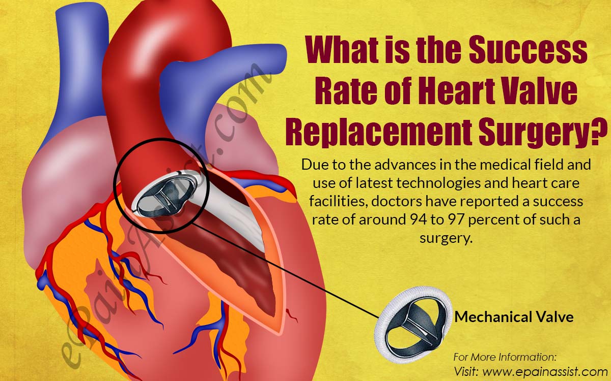 What is the Success Rate of Heart Valve Replacement Surgery?