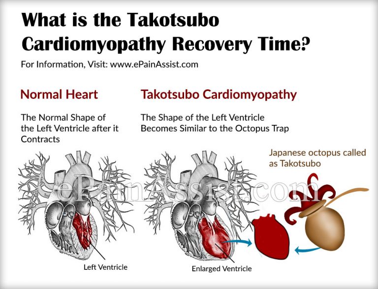 What is the Takotsubo Cardiomyopathy Recovery Time?