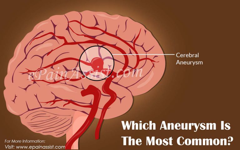 Which Aneurysm Is The Most Common?