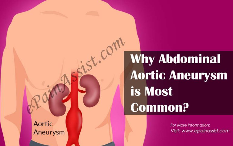 Why Abdominal Aortic Aneurysm is Most Common?