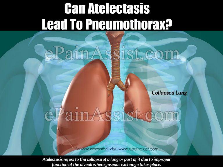 Can Atelectasis Lead To Pneumothorax?