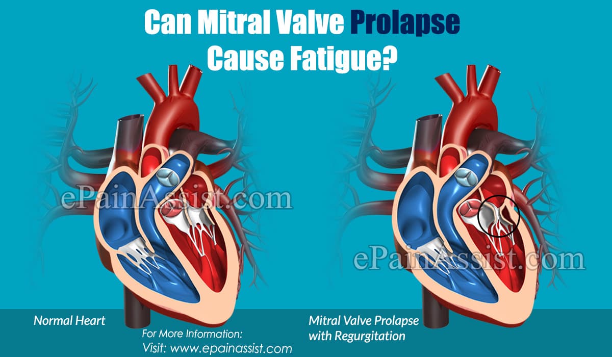 Can Mitral Valve Prolapse Cause Fatigue?