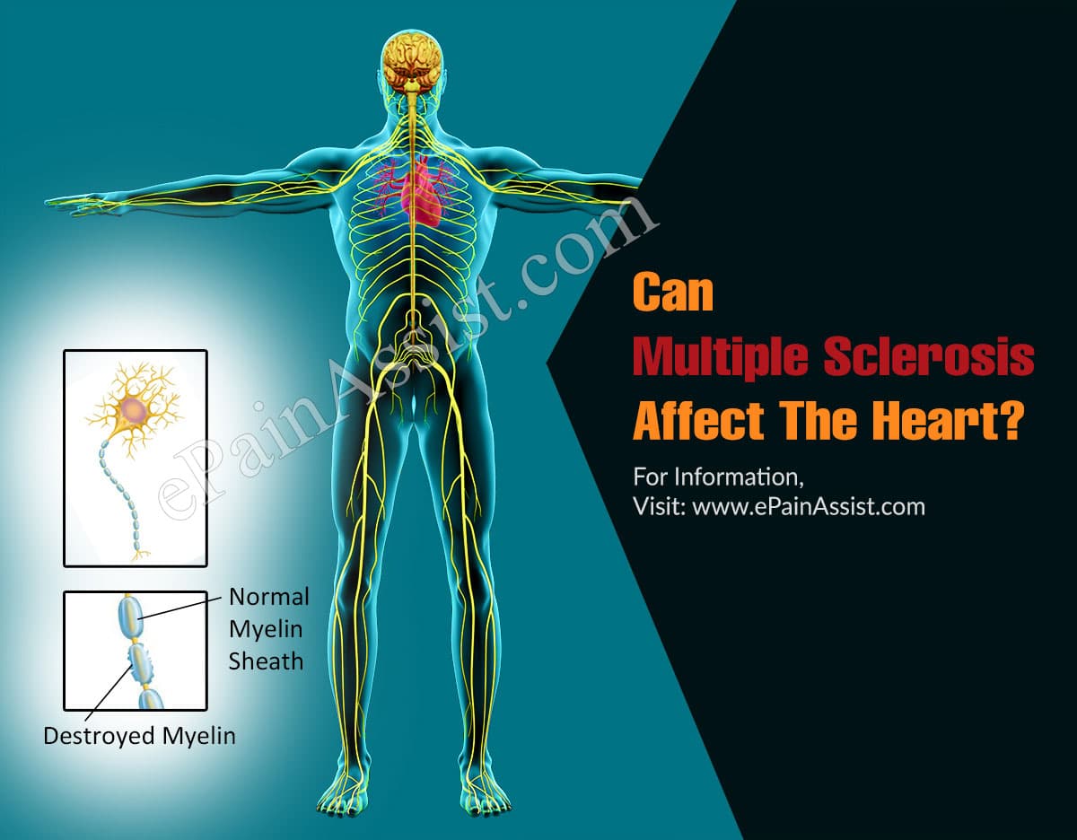 Can Multiple Sclerosis Affect The Heart?