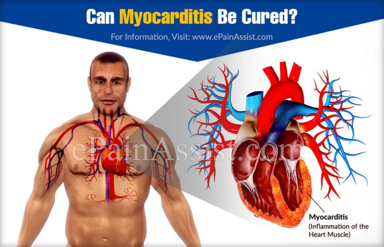 Can Myocarditis Be Cured?