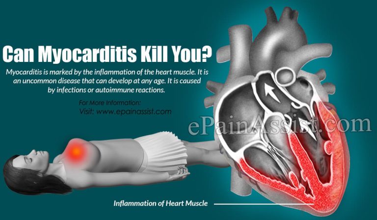 Can Myocarditis Kill You?