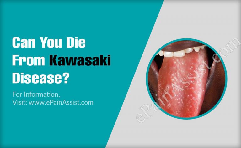 Can You Die From Kawasaki Disease?