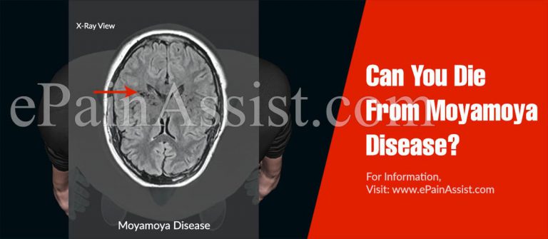 Can You Die From Moyamoya Disease?