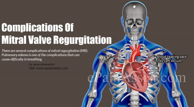 Complications Of Mitral Valve Regurgitation