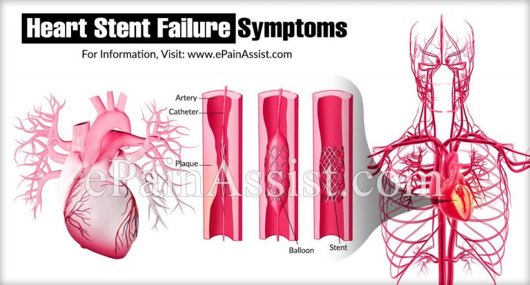Heart Stent Failure Symptoms