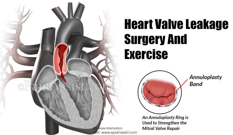 Heart Valve Leakage Surgery And Exercise
