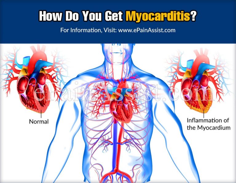 How Do You Get Myocarditis & How Do You Know If You Have It?