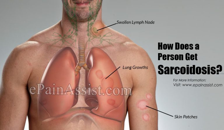 How Does a Person Get Sarcoidosis?