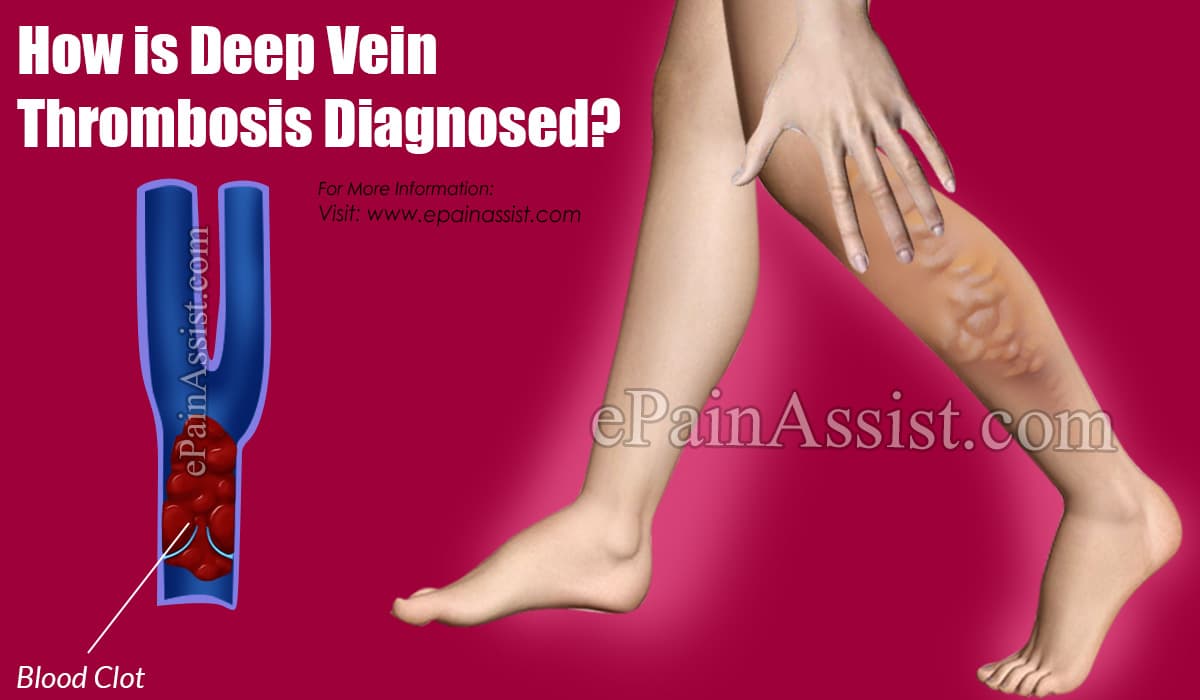 How is Deep Vein Thrombosis Diagnosed?