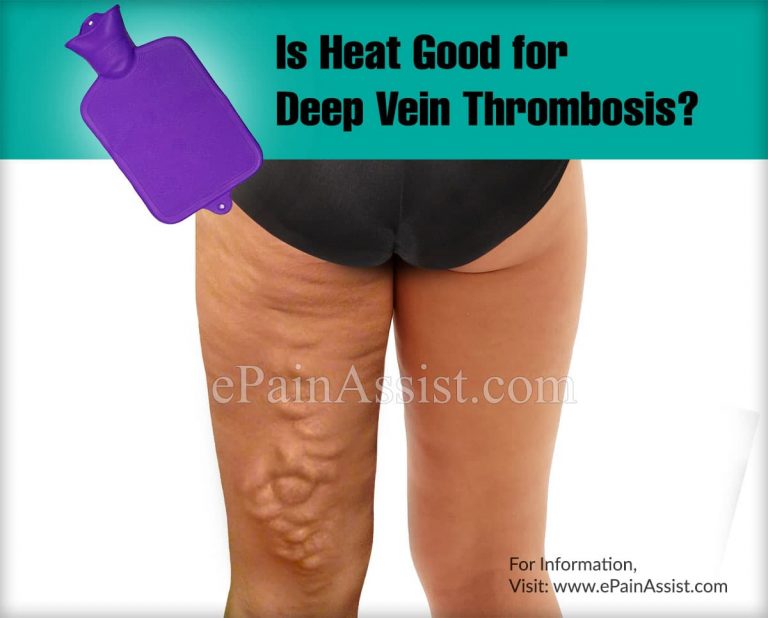 Is Heat Good for Deep Vein Thrombosis?