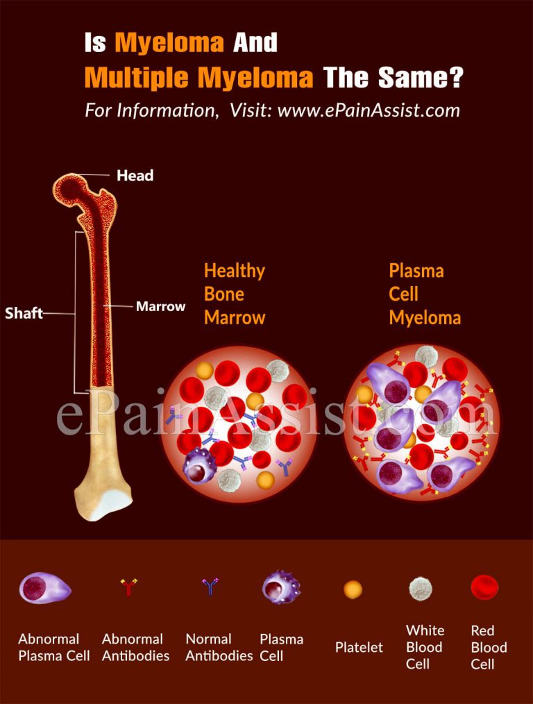 Is Myeloma And Multiple Myeloma The Same?