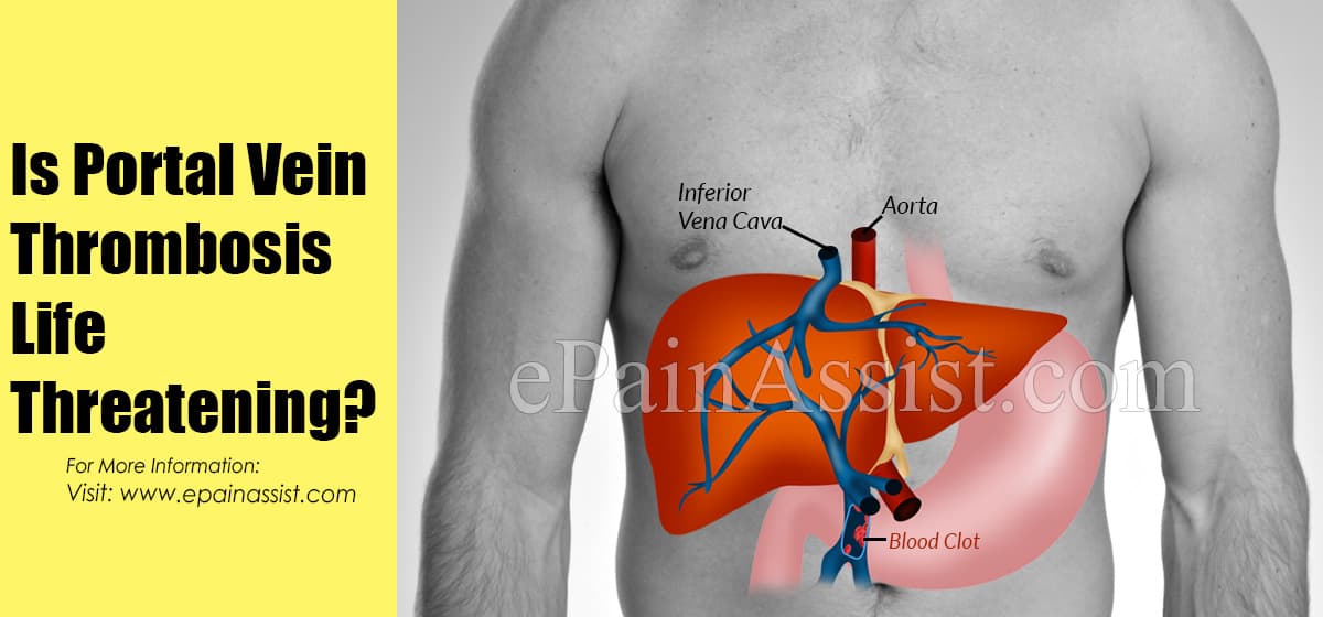 Is Portal Vein Thrombosis Life Threatening?