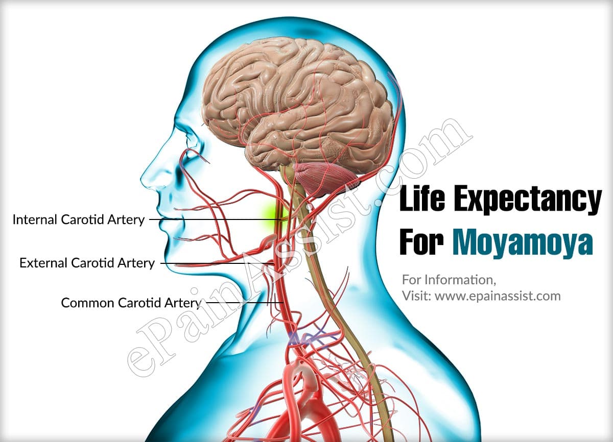 Life Expectancy For Moyamoya