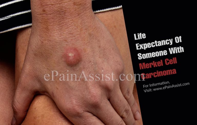Life Expectancy Of Someone With Merkel Cell Carcinoma