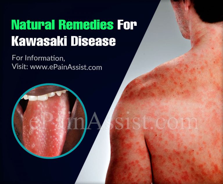 Natural Remedies For Kawasaki Disease